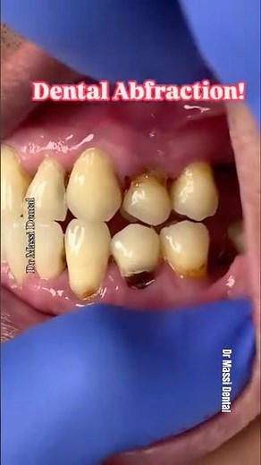 Dental Abfraction