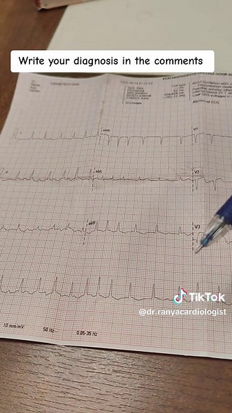 Understanding ECG Interpretation in Cardiology