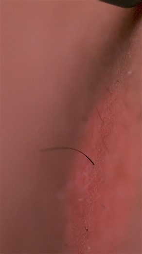 LaserAway on Instagram: "Tick, tick, tick BOOM goes the hair follicle. Our state-of-the-art laser technology targets deep within your skin to permanently reduce unwanted hair at the source. By reducing the need to shave or wax, Laser Hair Removal keeps skin softer, smoother, and irritation-free—saving you time *and* money."