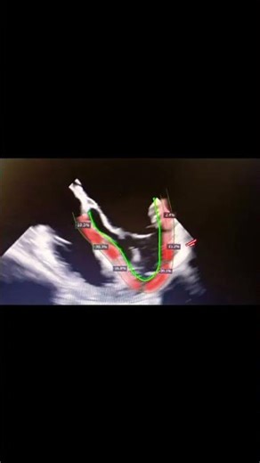 Assessment of LV STRAIN by Speckle Tracking in TEE !!