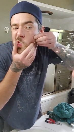 pimplepopping.tv on Instagram: "LIKE OR NOT ? Comment Below 🥰 . . . 🏷: #pimple #pimplepopping #pores #pimplepop #pimples #acne #blackheads #whiteheads #blackheads #blackheadremover #blackhead"