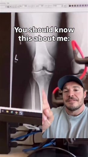 Did you know we can just replace one compartment of the knee at a time? I'm sure @corycalendinemd does this often. He is the guy I know btw. Anyway, this procedure is called a unicompartment knee replacement. 🦵With unicompartmental knee replacement, the recovery is quicker than standard total knee replacement. You generally go home the same day after surgery, and you start doing therapy right away. Typically you can get back to more activities than you can after a total knee replacement. The ou