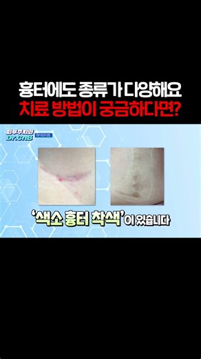 흉터종류, 이렇게나 많습니다! 치료방법이 궁금하다면? #흉터치료 #여드름흉터 #봉합흉터 #외상흉터 #인천흉터치료 #인천피부과 #shorts #short