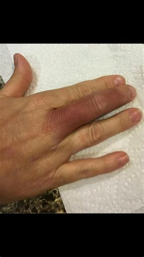 Ahmed Abdul Hussein on Instagram‎: "نايس كيس كيس متحول على أنه راينويد heavy workup for connective tissue disease was done to exclude secondary Raynaud. but initial simple test was missed: doppler for arterial system, which show no vasospasm, but hematoma. بالهستري، البيشنت ذكر عنده نفس الحالة قبل أكثر من سنة.. هاي الحالة أسمها Paroxysmal Finger Hematoma Or Achenbach syndrome... benign prognosis responded to cold sponge +/- NSAIDs."‎
