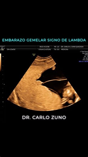 👶 El signo Lambda (o "signo del pico gemelar" / twin peak sign) es una imagen clave que se busca en las ecografías de embarazos gemelares para saber un dato crucial: si los bebés comparten o no la misma placenta. 🧐 ¿Qué es y qué indica? * ¿Qué es? Es una forma triangular o en forma de la letra griega Lambda (lambda) que se ve en la ecografía justo donde la membrana que separa a los dos bebés se une a la placenta. * Este "triángulo" es, en realidad, tejido de la placenta (corion) que se mete en