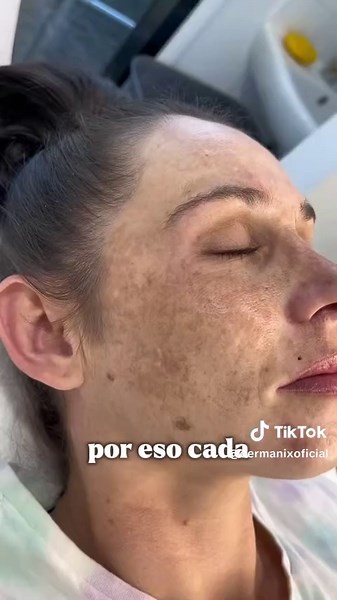 Cómo prevenir manchas en la piel por el sol