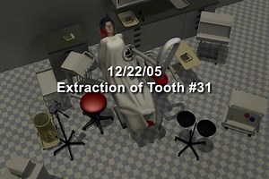Extraction of tooth #31