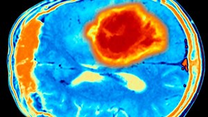 Gliomas | Peter O'Donnell Jr. Brain Institute | Condition | UT Southwestern Medical Center