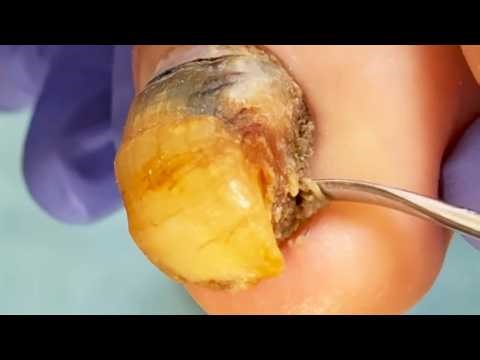 The Nails Are Curled Up Like Eggs, And They Can Be Treated By Trimming Them One By One