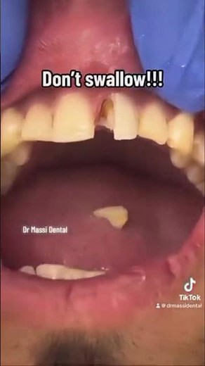 REMOVING TEMP CROWN AND INSERTING NEW CROWN