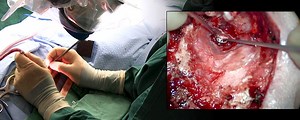 Revision Canal Wall Down Mastoidectomy with Mastoid Obliteration | Journal of Medical Insight