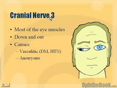 Neuro - Cranial Nerve 3 Palsy
