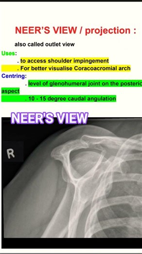 RADIOGRAPHER SPECIAL VIEW # NEER'S VIEW /outlet view