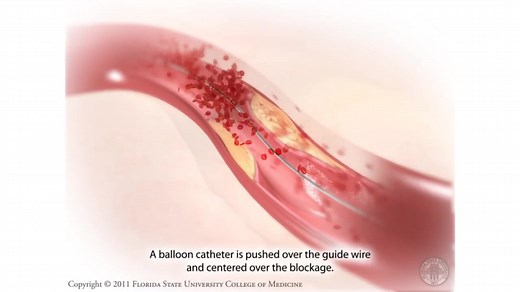 PCI-冠脉造影-冠脉植入术