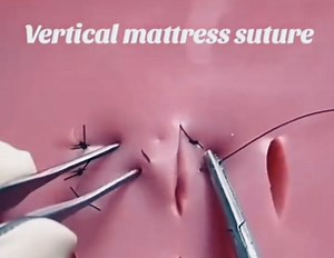 5.5K views · 178 reactions | Types of Sutures Sutures are a medical technique used to bring the edges of a wound or incision closer together to promote healing. Different types of sutures are primarily classified by method (separate or overlapping). You may also use other options such as staples or glue for specific types of wounds. | Troll medical life | Facebook