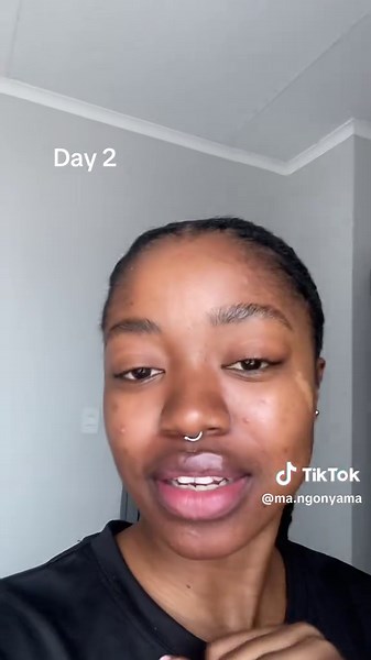 Skin Update: My Progress on Breakouts and Hyperpigmentation