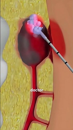 How Surgeons Remove a Painful Pilonidal Sinus (3D Animation) #pilonidalsurgery