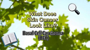 Did you know? Basal cell carcinoma (BCC) is the most common type of skin cancer, but it doesn’t always look the same. These photos give a general idea of what BCC can look like, but remember—BCCs can vary widely in appearance. Stay informed and protect your skin. For more on BCC and ways to prevent it, visit SkinCancer.org/bcc #SkinCancerAwareness #BCC #ProtectYourSkin | The Skin Cancer Foundation
