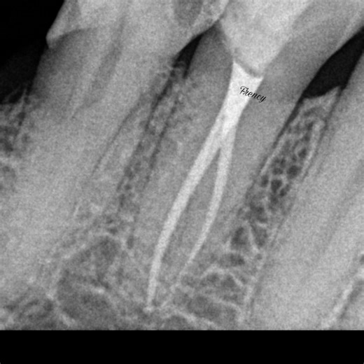 RCT ofandibular first premolar with two canals#premolar #endo #rootcanal #rct