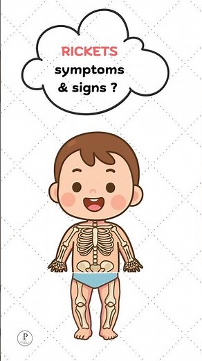 Symptoms and signs of Rickets in a child ?
