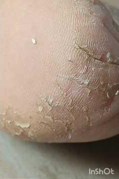 Cracked heels? Fix your feet at home in 1 night - Dry feet gone in minutes? YES Watch this #footrest