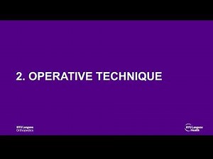 In Office Needle Endoscopic 4 Compartment Fasciotomy for Lower Leg Chronic Exertional Compartment Sy