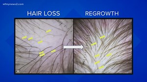 COVID: Hair loss & hair-shedding issues