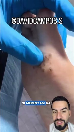 Verrugas nos pés (Olho de peixe): Como identificar e tratar?