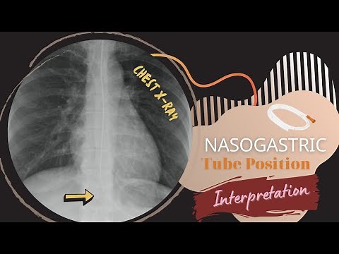 Chest X-ray Nasogastric Tube Position Interpretation