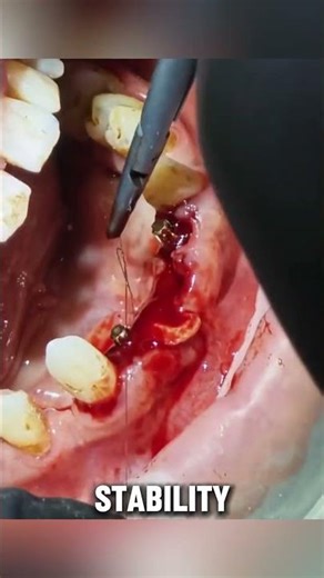From Loose Teeth to a New Smile - Immediate Implants #shorts #dentist #implant