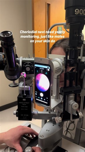 Using the slit lamp mount for the Eyer2 camera for a choriodial nevus on the patient’s retina. (Disclosure: this patient was asked and consented to this video before recording.) #eyedoctortiktok #optometrist #ophthalmology #eyedoctor