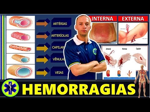 BLEEDS, WHAT ARE THE DIFFERENT TYPES?