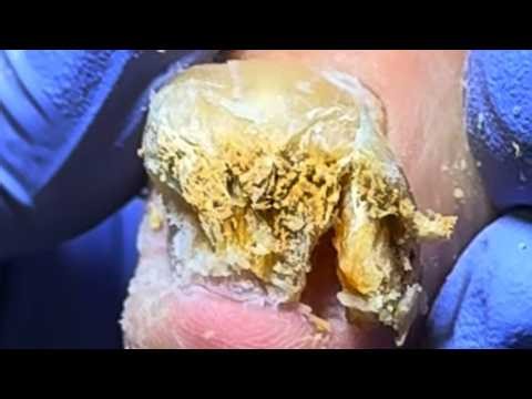 I Have Never Seen Such Thick Nails, Full Of Mud Inside【Xue Yidao】