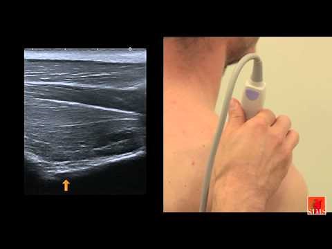 Échographie de l'épaule III