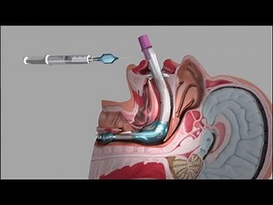 King LT #Laryngeal Tüp uygulaması