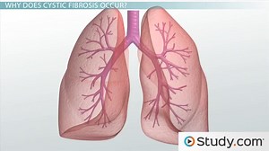 Cystic Fibrosis: Cause, Progression, and Treatment