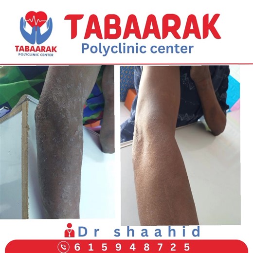 Waxaan ka shaqo bilaabay Xarunta caafimaadka ee TABAARAK POLY CLINIC...