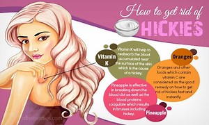28 Ways how to get rid of hickies fast and instantly