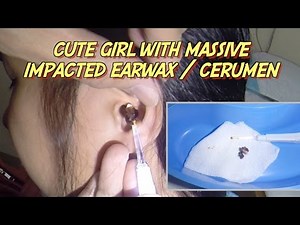 Cute Girl with Massive Impacted Earwax / Cerumen Removal