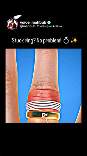 Voice Mahbub on Instagram: "Stuck ring? No problem! Did you know you can use a simple string to remove a tight ring without any pain? This "String Trick" uses compression to slide the ring right over the knuckle. #lifehacks #safetytips #didyouknow #reels #sciencefacts"