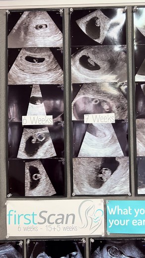 Here at window to the womb , we do first scans, here are some images for you to see and what you may expect at your first scan with us🩷🩵 #firstscan #wttwcroydon #baby #scanpictures #changes