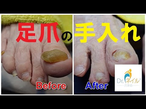 肥厚爪の施術【厚い爪のケア】（Thickened nails・THICK TOENAIL・두꺼워 손톱・足の爪切り）013