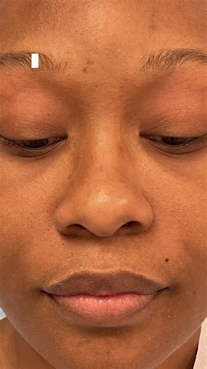 You don’t always need a full rhinoplasty. Sometimes, alarplasty or tip-plasty is all it takes to create symmetry, balance, and confidence. 👃🏽✨ Subtle changes. Big impact. #nosejob #nosejobbeforeandafter #rhinoplastyspecialist #rhinoplasty #nosejobresults