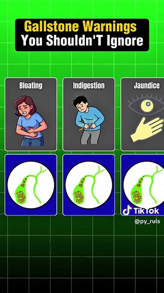 Gallstones: Understanding Gallbladder Health