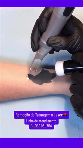 REMOÇÃO DE TATUAGENS COM MÁQUINA A LASER DE QUALIDADE A UM PREÇO MUITO BOM 🔥 Você tem uma tatuagem que não serve mais? Quer excluir de forma rápida, segura e econômica? 🎁 Somente neste mês: 👉 Ganhe 50% de desconto ao agendar uma consulta para remoção de tatuagem ⏳ Oferta por quantidade limitada. Reserve agora ou perca! 📩 Envie-me uma mensagem hoje mesmo - Vou aconselhá-lo detalhadamente! Aberto todos os dias da semana das 9:00 às 18:00 ☎️ 932 161 764 🕋 Talatona rua do SIAC , lado ao lado re