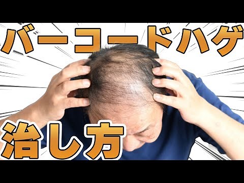 【AGA治療】バーコードハゲの改善方法や治し方を解説します。毛根再生注射