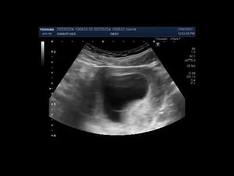 Missed Abortion of about 8 weeks.