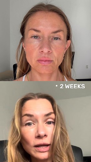 Facelift in Turkey ✨ UK's First Choice ---*--- MCAN Health is authorized by the Turkish Ministry of Health as an international health tourism center. All patients have provided consent for their photos to be shared on social media, specifically to assist foreign patients considering Turkey for medical tourism. This should not be viewed as advertising. All procedures will be carried out by a health institute accredited for health tourism. | MCAN Health | Facebook