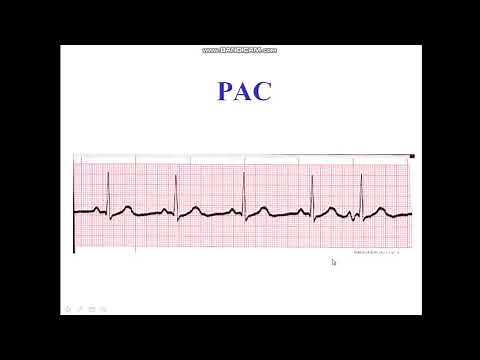Premature Atrial Complex ( Bigeminy / Trigeminy )