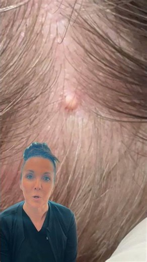 Milium extraction on the scalp